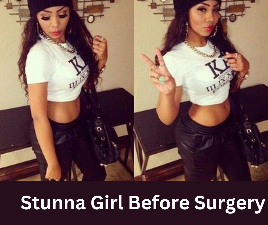 Stunna Girl Before Surgery: A Journey of Transformation Endowment - Celebrity Plastic Surgery