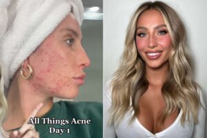alix-earle-acne-struggle