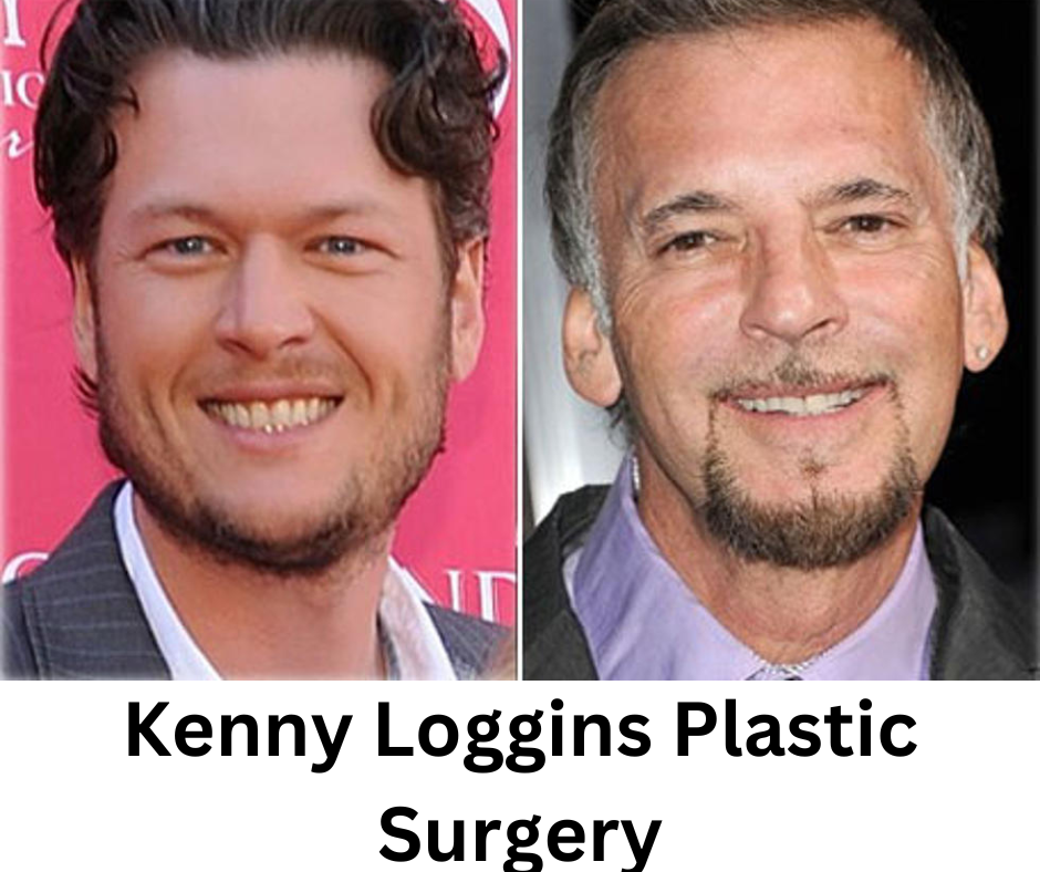 kenny loggins plastic surgery Image 7