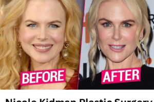 Nicole Kidman Plastic Surgery