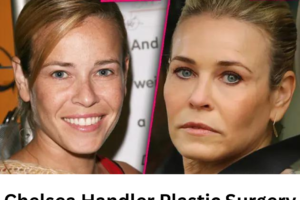 Chelsea Handler Plastic Surgery