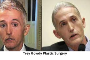 Trey Gowdy Plastic Surgery