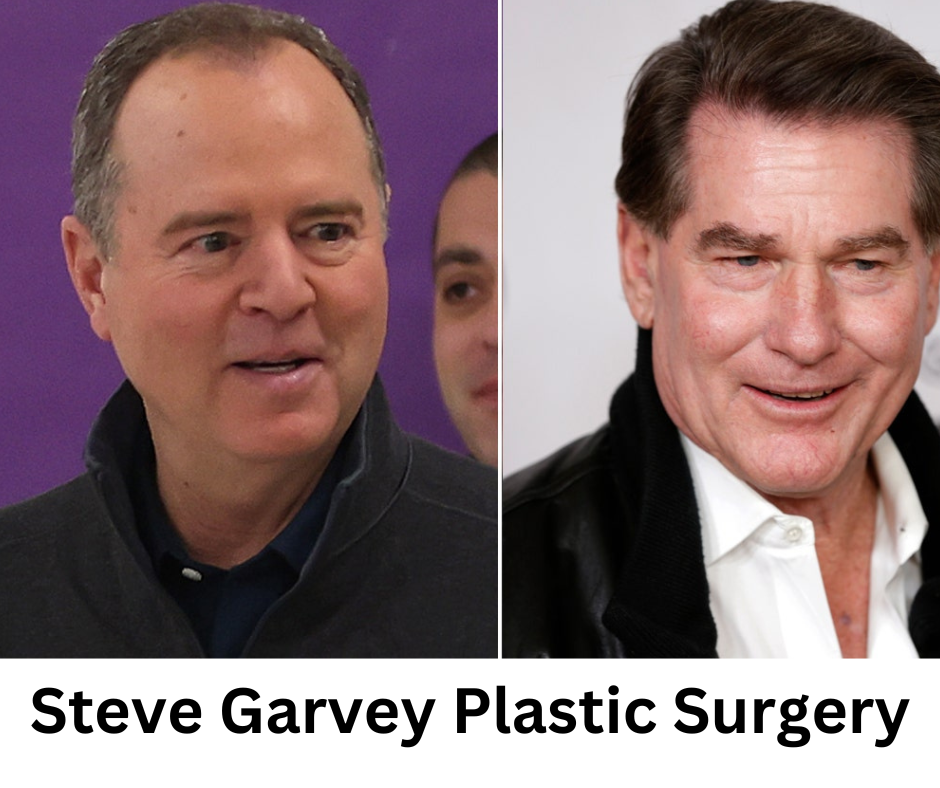 Featured - Steve Garvey Plastic Surgery