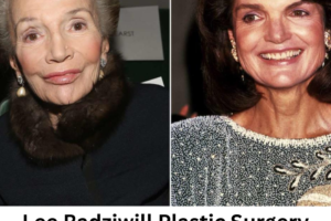 Lee Radziwill Plastic Surgery