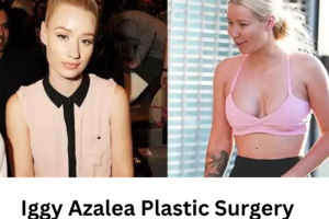 Iggy Azalea Plastic Surgery