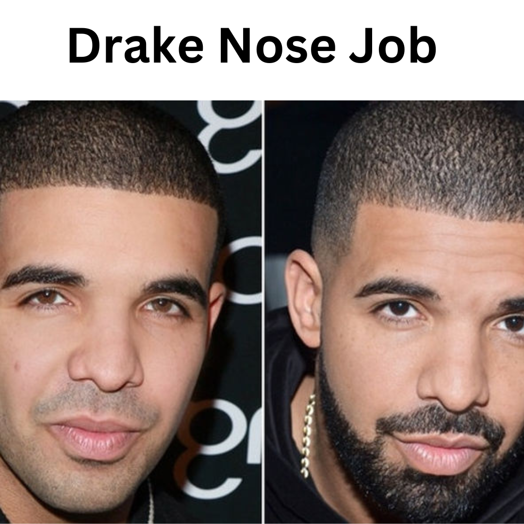 Drake Nose Job Journey and Its Impact on Plastic Surgery Trends
