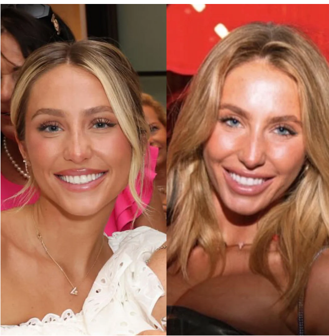 Alix Earle Plastic Surgery Rumors Separating Fact from Fiction(02)
