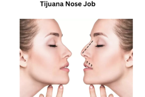 Tijuana Nose Job