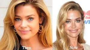 Denise Richards Plastic Surgery