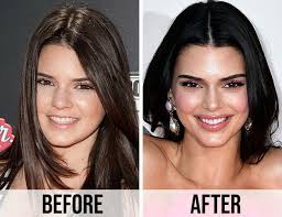 Kendall Jenner Before Plastic Surgery